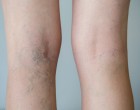 Sanatate: Ce sunt varicele si cum putem scapa de ele?