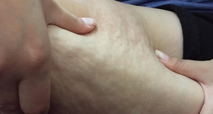 9 remedii naturale impotriva celulitei