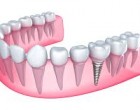 De ce sa apelezi la un tratament cu implant dentar?