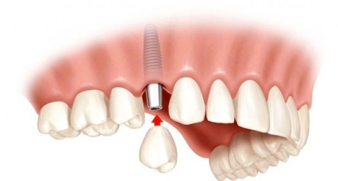 Ce trebuie facut inainte si dupa implantul dentar