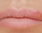 Cum scapi de herpes? 10 remedii naturiste!