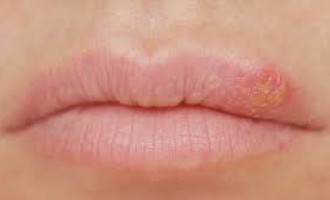 Cum scapi de herpes? 10 remedii naturiste!