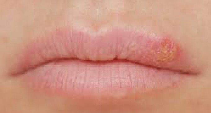 Cum scapi de herpes? 10 remedii naturiste!