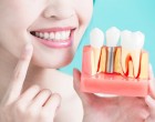 Cum ne poate ajuta implantul dentar să avem un zâmbet impecabil şi o viaţă normală?
