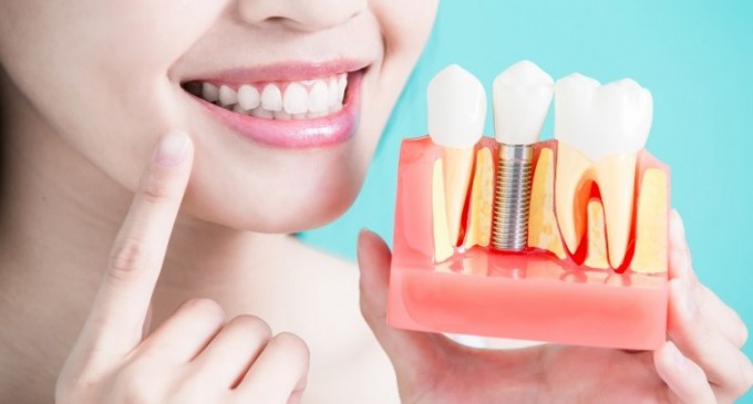 Cum ne poate ajuta implantul dentar să avem un zâmbet impecabil şi o viaţă normală?