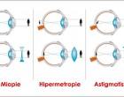 Tipuri de lentile de contact utilizate in corectarea miopiei si hipermetropiei