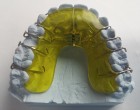 SUNT APARATELE DENTARE O MODA PENTRU ADULTI SI ADOLESCENTI?