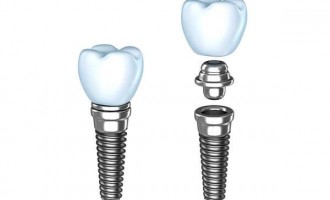 Lucruri interesante pe care trebuie sa le stii despre implantul dentar