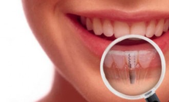 Avantajele oferite de un implant dentar corespunzator