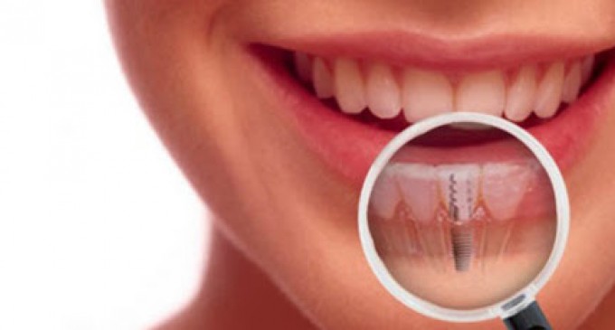 Avantajele oferite de un implant dentar corespunzator