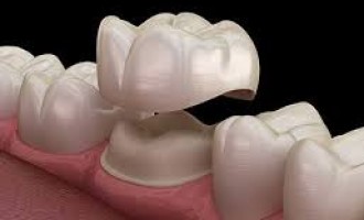 Coroana dentara. Avantaje, dezavantaje si recomandari