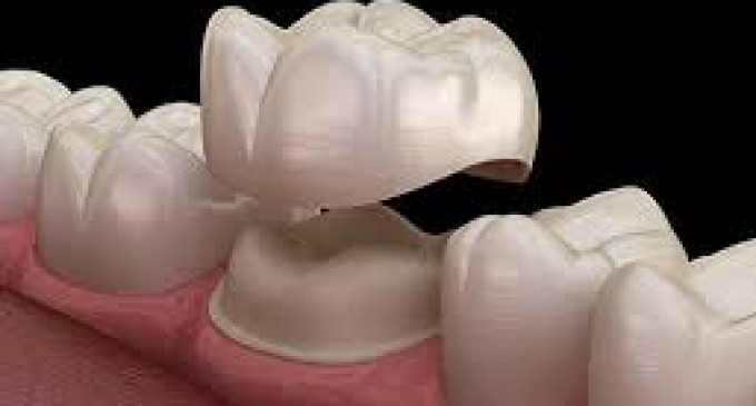 Coroana dentara. Avantaje, dezavantaje si recomandari