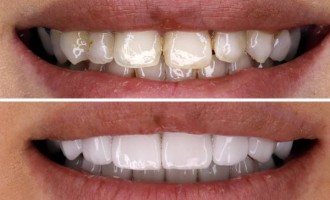 Fatetele dentare o alternativa foarte buna