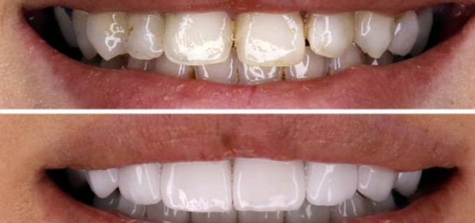 Fatetele dentare o alternativa foarte buna
