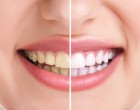 Care sunt avantajele si dezavantajele fatetelor dentare?
