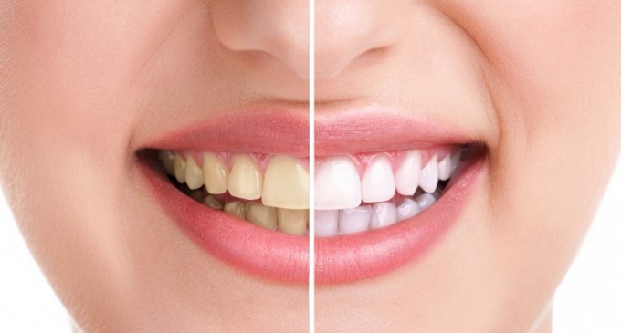 Care sunt avantajele si dezavantajele fatetelor dentare?