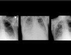 Premieră mondială: Transplant la plămâni pentru un pacient grav afectat de Covid-19 de la donatori în viață – Coronavirus