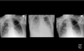 Premieră mondială: Transplant la plămâni pentru un pacient grav afectat de Covid-19 de la donatori în viață – Coronavirus