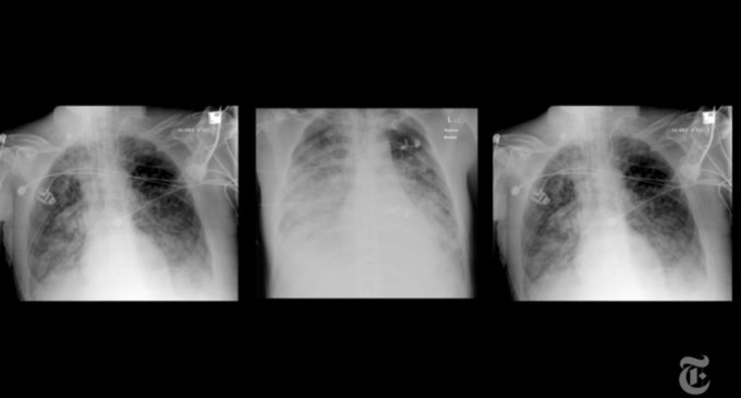 Premieră mondială: Transplant la plămâni pentru un pacient grav afectat de Covid-19 de la donatori în viață – Coronavirus