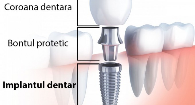 Soluția salvatoare în cazul dințiilor deteriorați