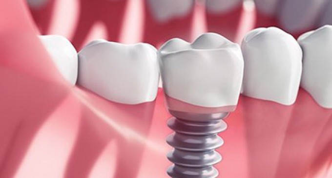 Fast and Fix implant dentar – Un zâmbet strălucitor și un nivel ridicat de confort