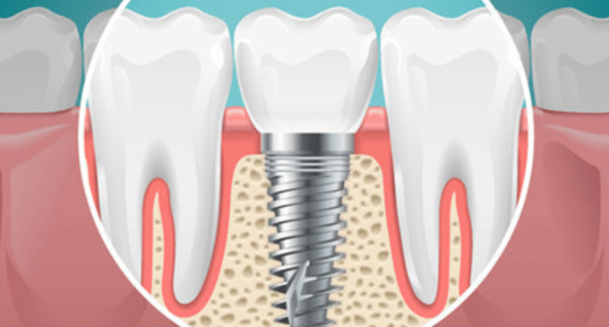 Fast and Fix implant dentar pentru un zâmbet frumos imediat