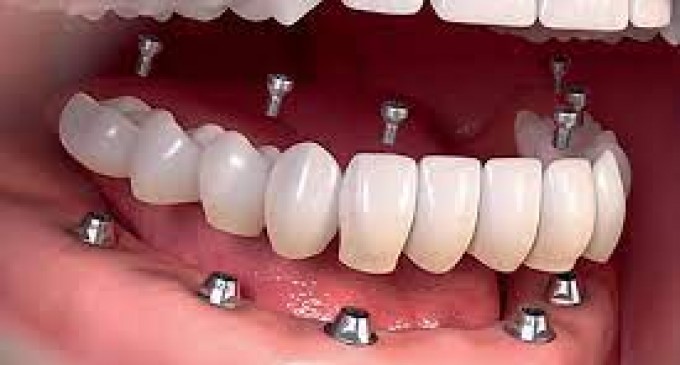 Ce tipuri de implanturi există și ce să alegi