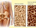 Legatura dintre bolile tiroidiene si osteoporoza