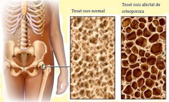 Legatura dintre bolile tiroidiene si osteoporoza