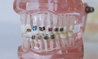 Aparatele dentare moderne corectează chiar şi problemele ce ţin de aspectul şi alinierea dinţilor pacienţilor adulţi