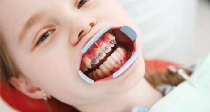 De ce este important tratamentul ortodontic timpuriu la copii?