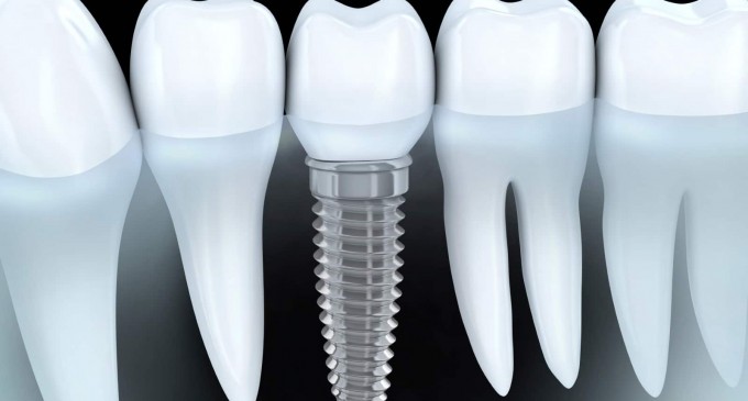 Implantul dentar, top 4 beneficii  pe care trebuie sa le stii