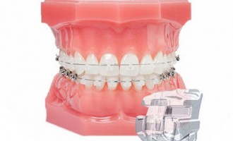 Cum știi că ai nevoie de aparat dentar?