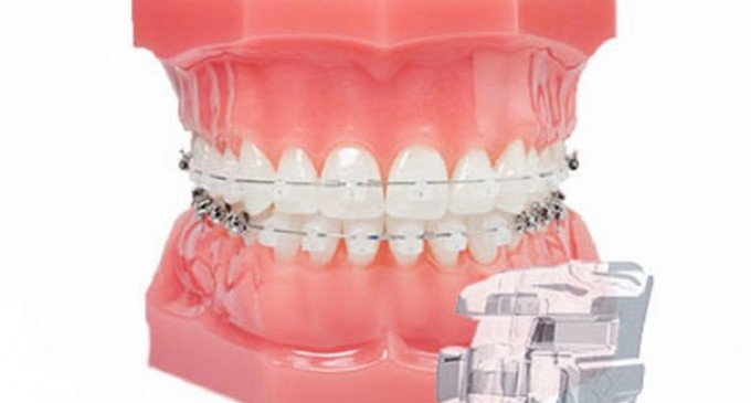 Cum știi că ai nevoie de aparat dentar?