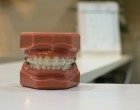 Semne care își arată că ai nevoie să porți aparat dentar