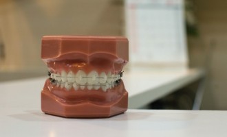 Semne care își arată că ai nevoie să porți aparat dentar