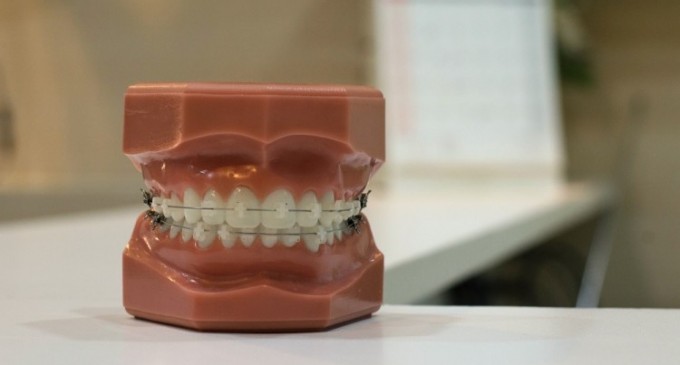 Semne care își arată că ai nevoie să porți aparat dentar
