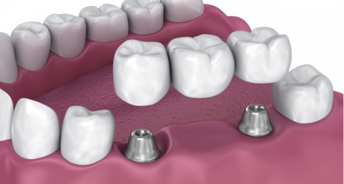 Ce trebuie sa stii despre implantul dentar si proteza dentara? Care este o alternativa mai avantajoasa?