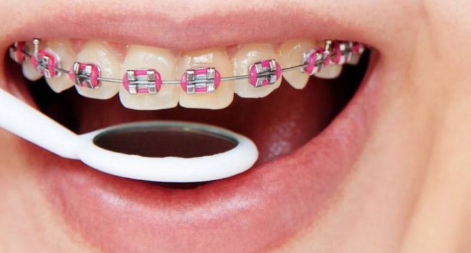 Ce ingiena adopti pentru a preveni aparitia cariilor atunci cand ai aparat dentar?