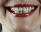 Cum poți preveni apariția parodontozei?