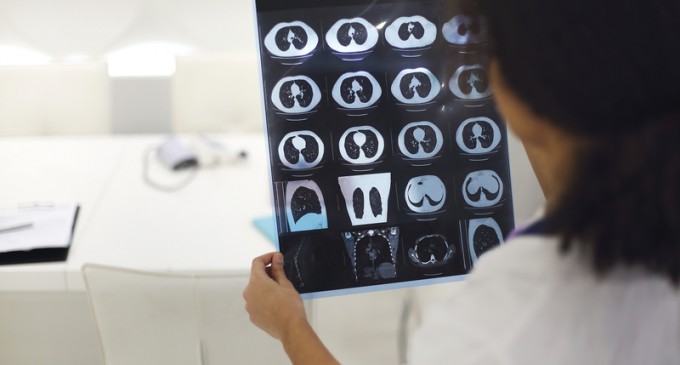 De ce un program de screening pentru cancerul bronhopulmonar este vital: Este principala cauză de deces prin cancer în România, iar 3 sferturi dintre pacienți sunt diagnosticați abia în stadiile 3 și 4