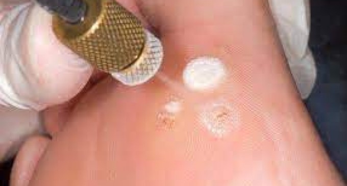 Ce trebuie sa stii despre crioterapie