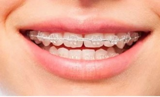 Cât costă un aparat dentar? Iată care sunt cele mai ieftine și cele mai scumpe aparate dentare