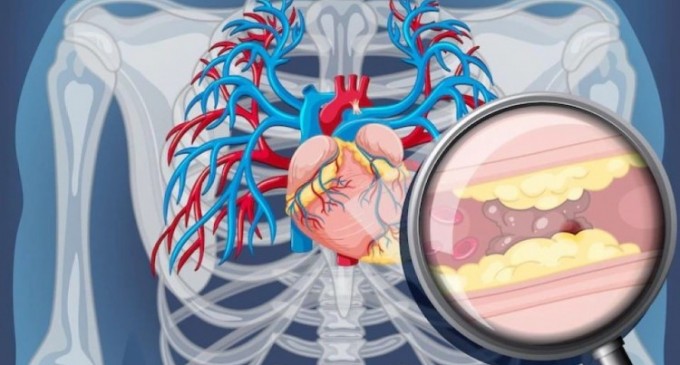 Tot ce trebuie să știi despre coronarografie