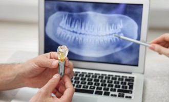 De la ce vârstă putem apela la montarea implanturilor dentare