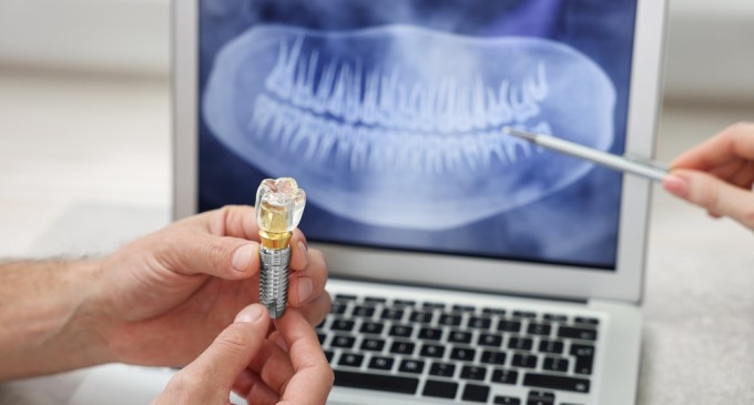 De la ce vârstă putem apela la montarea implanturilor dentare