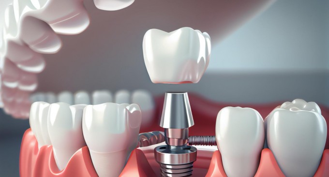 Inlocuirea dintilor lipsa – Proteze dentare sau implant dentar