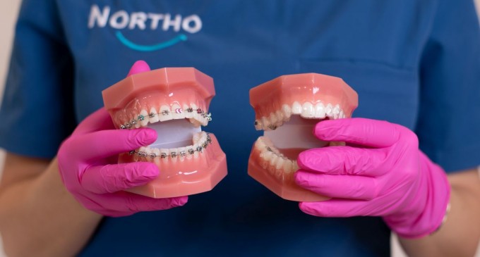 Aparat dentar invizibil: solutia zambetului perfect chiar si pe durata tratamentului!