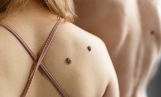 Când ar trebui să vizităm dermatologul pentru alunițe