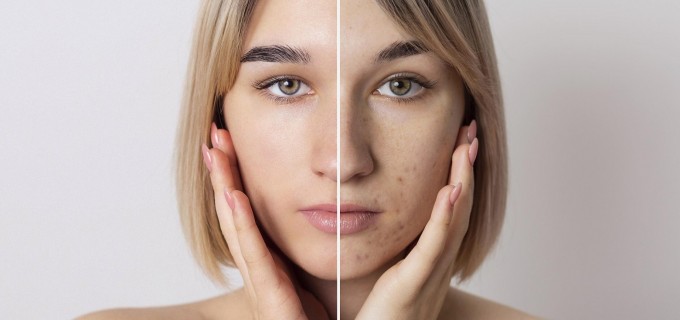 Acneea la adulți: cauze, rutina corectă, tratament și microneedling